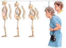 Photo of أعراض هشاشة العظام عند النساء