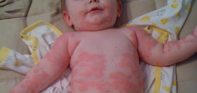 Photo of متى تظهر حساسية الحليب عند الرضع