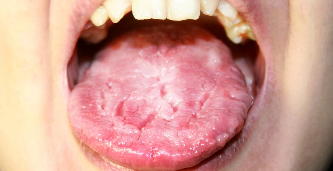Photo of أدوية علاج فطريات الفم واللسان