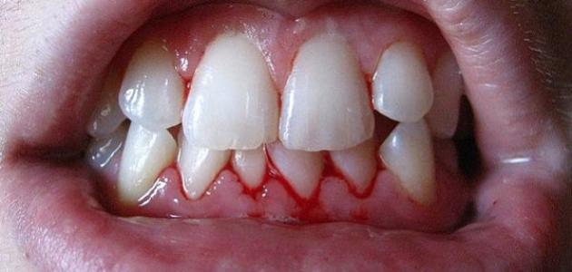 Photo of تفسير حلم خروج الدم من الأسنان