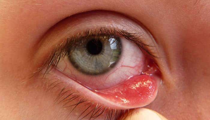 Photo of أدوية علاج الكيس الدهني في العين