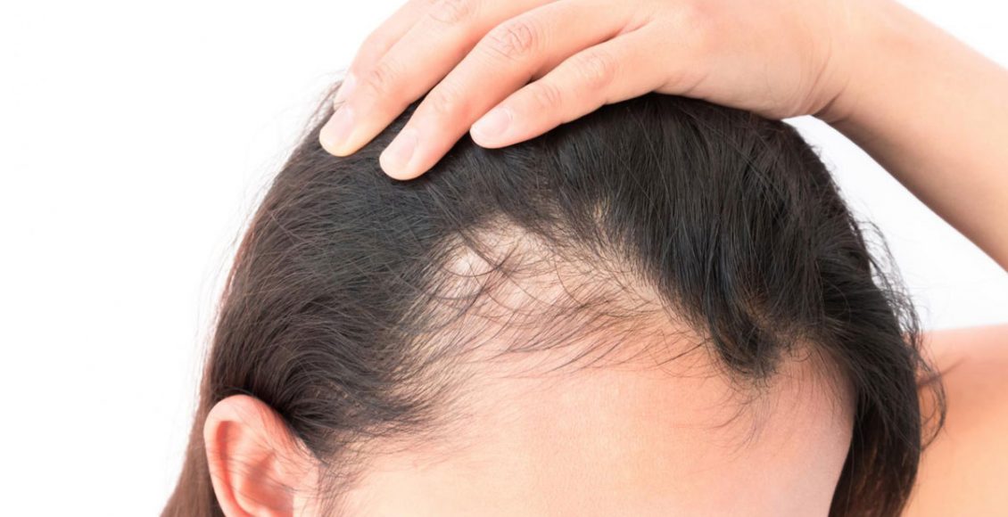 Photo of أفضل علاج لتساقط الشعر عند النساء