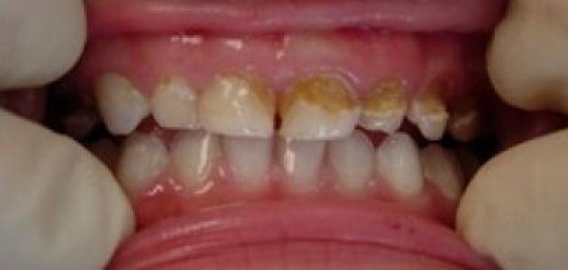 Photo of علاج الأسنان المتآكلة عند الأطفال