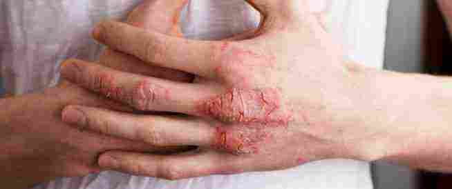 Photo of علاج الأكزيما في اليد نهائيا