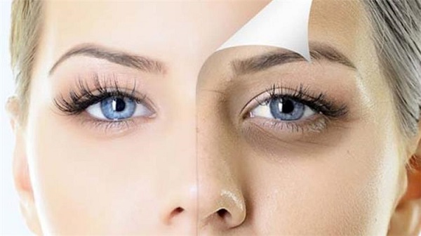 Photo of 8 وصفات لعلاج الهالات السوداء حول العين نهائيًا بطريقة سريعة