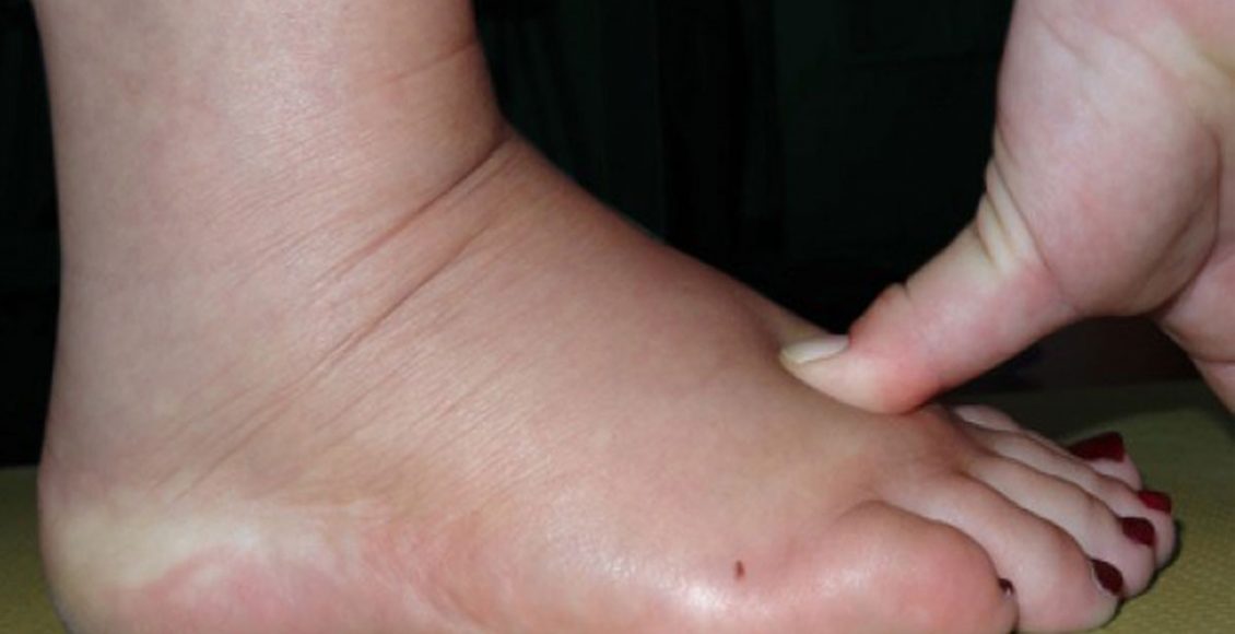 Photo of علاج انتفاخ القدمين بسبب الأملاح