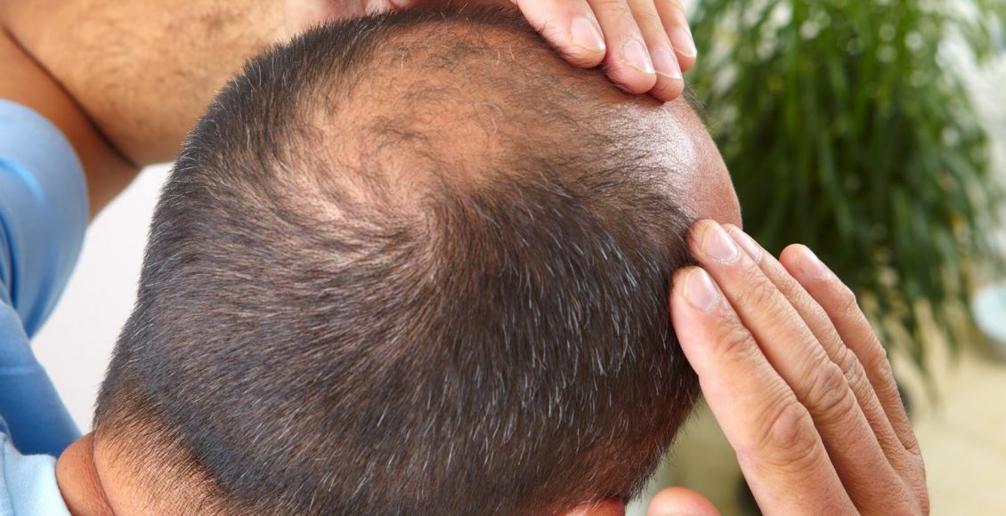 Photo of علاج تساقط الشعر عند الرجال بوصفات الطبيعية