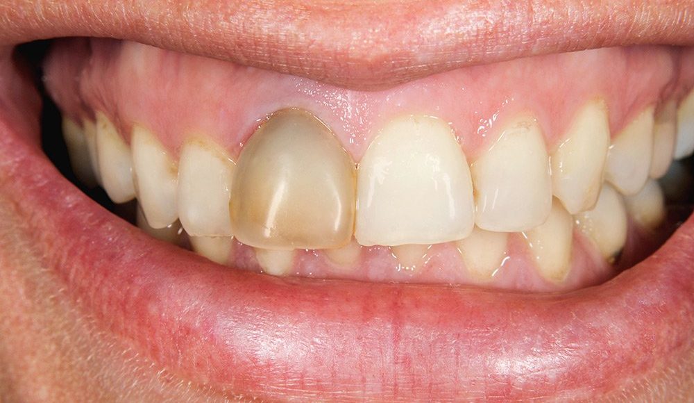 Photo of علاج تسوس الأسنان الأمامية في المنزل
