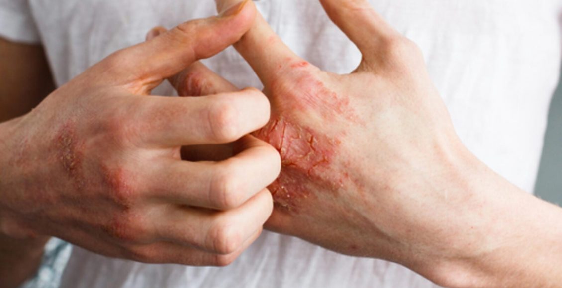 Photo of علاج حساسية الجلد من الكلور