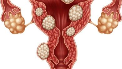 اعراض الورم الليفي في الرحم