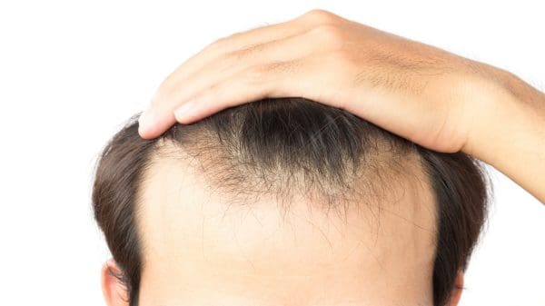 تكلفة زراعة الشعر في تركيا 2024 بالدولار والدينار الجزائري والريال السعودي