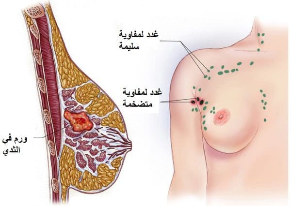 ما هي مواصفات الكتلة السرطانية في الثدي؟