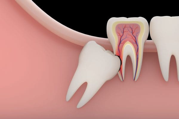 6 تعليمات هامة يجب اتباعها بعد خلع ضرس العقل جراحيًا