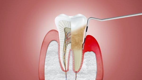 أسهل طرق علاج التهاب اللثة