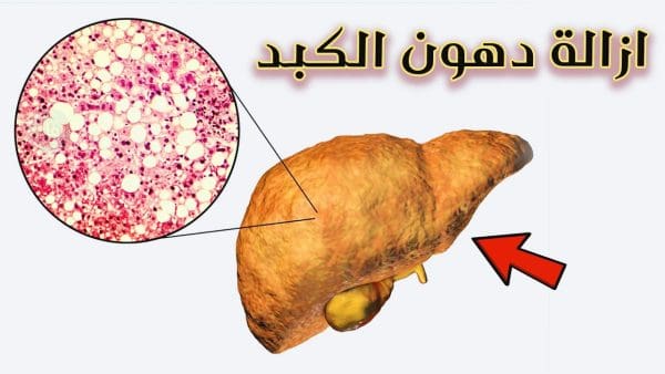 أسهل طريقة لإزالة دهون الكبد