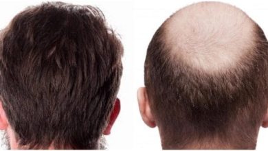 تجربتي مع زراعة الشعر