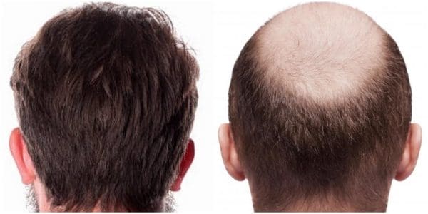 تجربتي مع زراعة الشعر