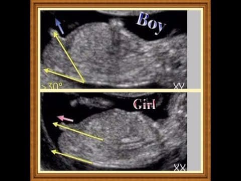 طرق التعرف على جنس الجنين بدون سونار