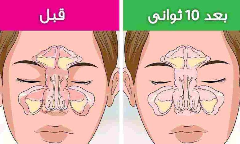 علاج الجيوب الأنفية للحامل