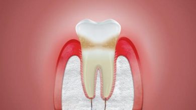 كيفية علاج نزول اللثة وتعري الأسنان والوقاية منها