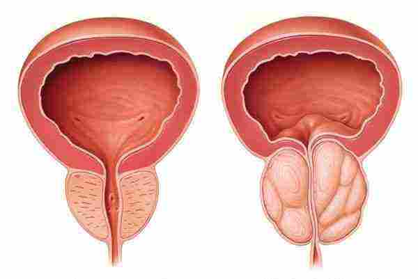 ما هي البروستاتا عند الرجال