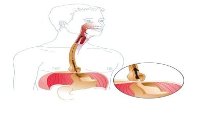 هل ارتجاع المريء يسبب الوفاة أم لا؟