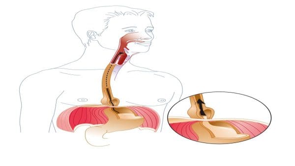 هل ارتجاع المريء يسبب الوفاة أم لا؟