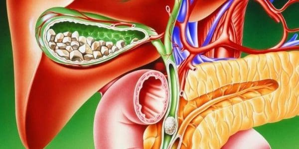 وصفة طبيعية مجربة للتخلص من حصوات المرارة