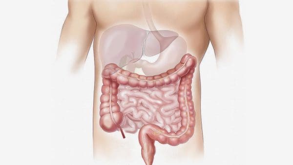 علاج التهاب الزائدة الدودية بالاعشاب