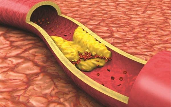 علاج للقضاء على الدهون الثلاثية والكولسترول .. وتخفيف الوزن